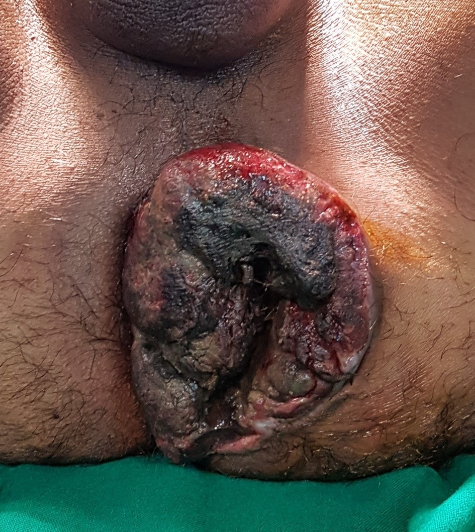 Gangrenous / Strangulated Piles — clinical photograph
