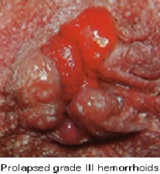 Prolapsed Grade III Haemorrhoids — clinical photograph