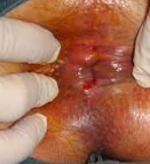 Post-Procedure Anal Canal — clinical photograph
