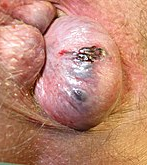 Thrombosed External Pile — clinical photograph