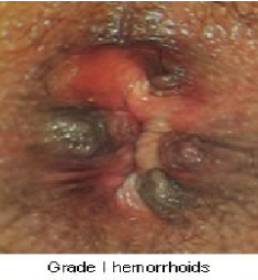 Grade I Haemorrhoids — clinical photograph