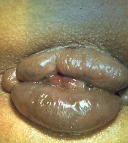 Large Circumferential Piles — clinical photograph