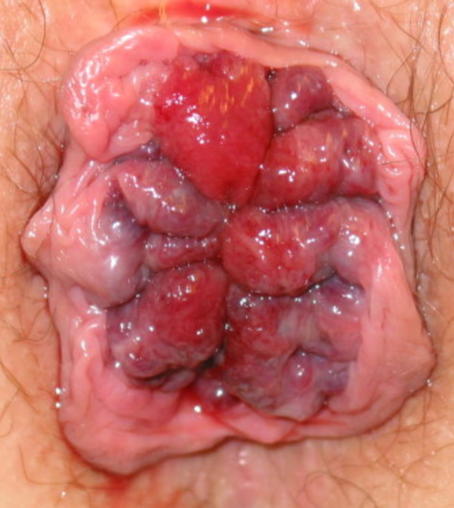 Acutely Inflamed Piles — clinical photograph