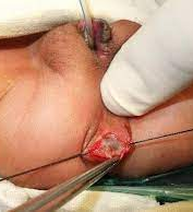 Pile Mass Under Treatment — clinical photograph