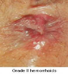 Grade II Haemorrhoids — clinical photograph
