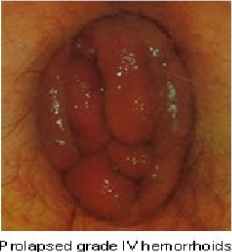 Prolapsed Grade IV Haemorrhoids — clinical photograph
